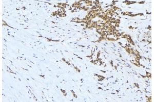 ABIN6275653 at 1/100 staining Human lung cancer tissue by IHC-P. (USP19 抗体  (Internal Region))