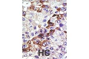 Formalin-fixed and paraffin-embedded human cancer tissue reacted with the primary antibody, which was peroxidase-conjugated to the secondary antibody, followed by AEC staining. (UBE2E3 抗体  (N-Term))