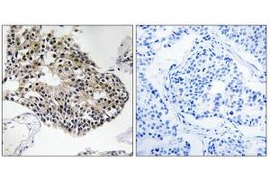 Immunohistochemistry analysis of paraffin-embedded human breast carcinoma tissue using RPS25 antibody. (RPS25 抗体  (C-Term))