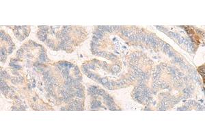 Immunohistochemistry of paraffin-embedded Human thyroid cancer tissue using COG4 Polyclonal Antibody at dilution of 1:30(x200) (COG4 抗体)
