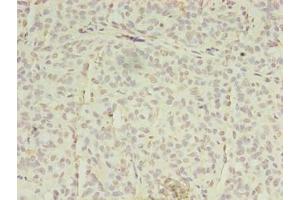 Immunohistochemistry of paraffin-embedded human breast cancer using ABIN7151851 at dilution of 1:100 (EPH Receptor A7 抗体  (AA 28-182))