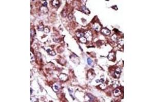 Formalin-fixed and paraffin-embedded human cancer tissue reacted with the primary antibody, which was peroxidase-conjugated to the secondary antibody, followed by AEC staining. (NME7 抗体  (N-Term))