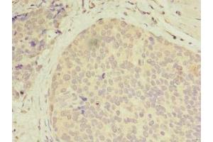 Immunohistochemistry of paraffin-embedded human gastric cancer using ABIN7146141 at dilution of 1:100 (CXCL6 抗体  (AA 38-114))