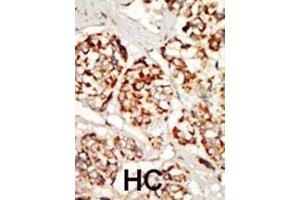 Formalin-fixed and paraffin-embedded human cancer tissue reacted with the primary antibody, which was peroxidase-conjugated to the secondary antibody, followed by DAB staining. (KSR1 抗体  (N-Term))