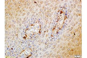 Formalin-fixed and paraffin embedded human endometrium carcinoma labeled with Rabbit Anti-Matriptase Polyclonal Antibody, Unconjugated at 1:100 followed by conjugation to the secondary antibody and DAB staining. (ST14 抗体  (AA 11-100))
