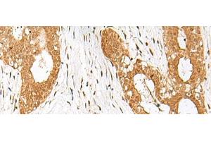 Immunohistochemistry of paraffin-embedded Human breast cancer tissue using IPO11 Polyclonal Antibody at dilution of 1:70(x200) (Importin 11 抗体)