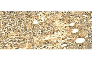 Immunohistochemistry of paraffin-embedded Human ovarian cancer using ECE2 Polyclonal Antibody at dilution of 1/25 (ECE2 抗体)
