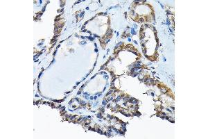 Immunohistochemistry of paraffin-embedded human thyroid cancer using RBBP9 Rabbit pAb (ABIN6129095, ABIN6146752, ABIN6146753 and ABIN6220638) at dilution of 1:200 (40x lens). (RBBP9 抗体  (AA 1-186))