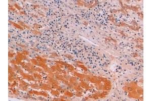 Detection of β-catenin in Human Liver cancer Tissue using Monoclonal Antibody to Beta Catenin (β-catenin) (beta Catenin 抗体  (AA 439-675))