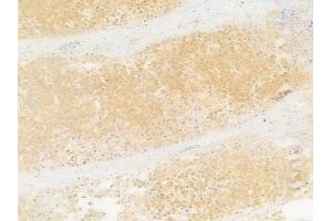 ABIN7093228 and ABIN7097240 at 1/100 staining human prostate carcinoma by IHC-P.