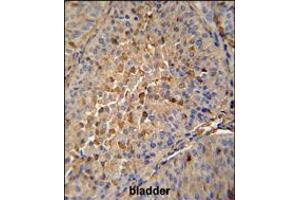 MAPRE1 antibody immunohistochemistry analysis in formalin fixed and paraffin embedded human bladder carcinoma followed by peroxidase conjugation of the secondary antibody and DAB staining. (MAPRE1 抗体  (N-Term))