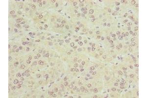 Immunohistochemistry of paraffin-embedded human liver cancer using ABIN7147940 at dilution of 1:100 (CIPC/KIAA1737 抗体  (AA 1-399))