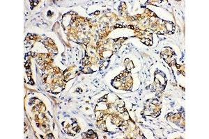 IHC-P: SERCA2 ATPase antibody testing of human breast cancer tissue (SERCA2 ATPase (Middle Region) 抗体)