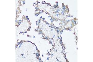 Immunohistochemistry of paraffin-embedded human lung cancer using Src antibody (ABIN6132240, ABIN6148428, ABIN6148429 and ABIN6215399) at dilution of 1:100 (40x lens). (Src 抗体  (AA 1-80))