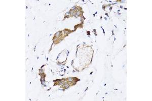 Immunohistochemistry of paraffin-embedded human breast cancer using N antibody (ABIN6129932, ABIN6144318, ABIN6144319 and ABIN6222781) at dilution of 1:100 (40x lens). (NAA10 抗体  (AA 161-235))