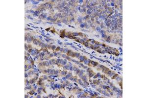 Immunohistochemistry of paraffin-embedded human thyroid cancer using SNCG antibody (ABIN5971355) at dilution of 1/200 (40x lens). (SNCG 抗体)