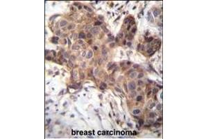 GDF9 Antibody (N-term) (ABIN656116 and ABIN2845455) immunohistochemistry analysis in formalin fixed and paraffin embedded human breast carcinoma followed by peroxidase conjugation of the secondary antibody and DAB staining. (GDF9 抗体  (N-Term))