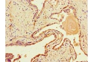 Immunohistochemistry of paraffin-embedded human prostate cancer using ABIN7150861 at dilution of 1:100 (DNAH1 抗体  (AA 2225-2407))