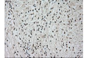 Immunohistochemical staining of paraffin-embedded Carcinoma of kidney tissue using anti-NTRK3mouse monoclonal antibody. (NTRK3 抗体)