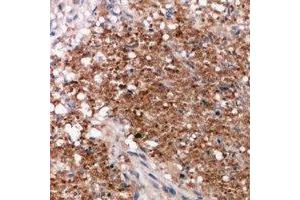 Immunohistochemical analysis of Vimentin staining in human breast cancer formalin fixed paraffin embedded tissue section. (Vimentin 抗体  (C-Term))