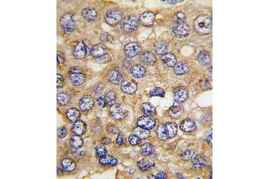 Formalin-fixed and paraffin-embedded human hepatocarcinoma tissue reacted with PFKFB4 antibody , which was peroxidase-conjugated to the secondary antibody, followed by DAB staining. (PFKFB4 抗体  (AA 266-296))