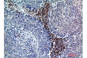 Immunohistochemistry (IHC) analysis of paraffin-embedded Human Breast Cancer, antibody was diluted at 1:200. (BATF3 抗体)