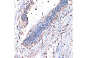 Immunohistochemistry of paraffin-embedded human colon carcinoma using CD44 antibody (ABIN3021912, ABIN3021913, ABIN3021914 and ABIN6217536) at dilution of 1:200 (40x lens). (CD44 抗体  (AA 35-300))