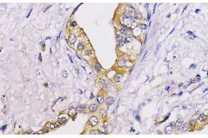 Immunohistochemistry of paraffin-embedded Human lung cancer using Bcl-2 Polyclonal Antibody at dilution of 1:100 (40x lens). (Bcl-2 抗体)