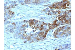 Formalin-fixed, paraffin-embedded human Colon Carcinoma stained with Blood Group Antigen H Type 2 Monoclonal Antibody (19-OLE) (ABO 抗体)