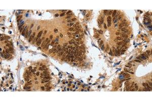 Immunohistochemistry of paraffin-embedded Human colon cancer using COPS5 Polyclonal Antibody at dilution of 1:120 (COPS5 抗体)