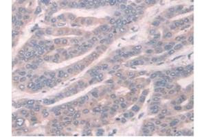 IHC-P analysis of Human Liver Cancer Tissue, with DAB staining. (TPMT 抗体  (AA 26-227))
