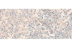 Immunohistochemistry of paraffin-embedded Human cervical cancer tissue using ERP27 Polyclonal Antibody at dilution of 1:35(x200) (ERP27 抗体)