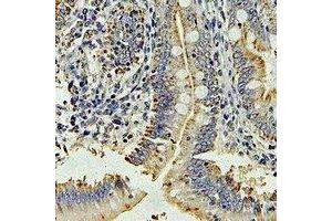 Immunohistochemical analysis of DPP3 staining in human colon cancer formalin fixed paraffin embedded tissue section. (DPP3 抗体)