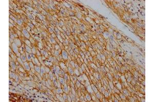IHC image of ABIN7127819 diluted at 1:100 and staining in paraffin-embedded human liver cancer performed on a Leica BondTM system. (Recombinant ATP1A1 抗体)