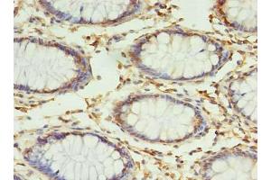 Immunohistochemistry of paraffin-embedded human colon cancer using ABIN7159947 at dilution of 1:100 (RPUSD4 抗体  (AA 41-240))