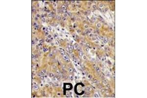 Formalin-fixed and paraffin-embedded human prostata carcinoma tissue reacted with MYO1C antibody (C-term), which was peroxidase-conjugated to the secondary antibody, followed by DAB staining. (Myosin ID 抗体  (C-Term))