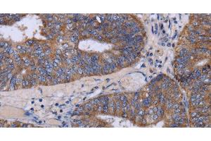 Immunohistochemistry of paraffin-embedded Human colon cancer tissue using MT3 Polyclonal Antibody at dilution 1:50 (MT3 抗体)