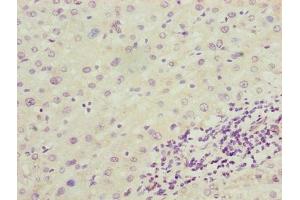 Immunohistochemistry of paraffin-embedded human liver cancer using ABIN7143865 at dilution of 1:100 (ENO1 抗体  (AA 2-428))