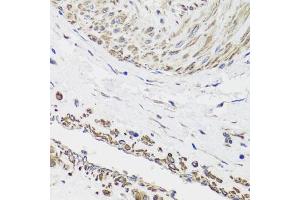Immunohistochemistry of paraffin-embedded human prostate cancer using DES antibody (ABIN5970272) at dilution of 1/100 (40x lens). (Desmin 抗体)