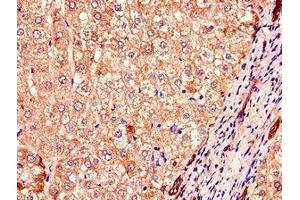 Immunohistochemistry of paraffin-embedded human liver cancer using ABIN7148300 at dilution of 1:100 (COMMD1 抗体  (AA 2-190))