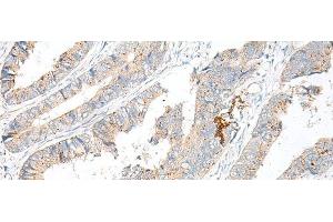 Immunohistochemistry of paraffin-embedded Human colorectal cancer tissue using GARNL3 Polyclonal Antibody at dilution of 1:60(x200) (GARNL3 抗体)