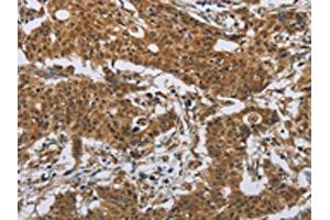 The image on the left is immunohistochemistry of paraffin-embedded Human gastric cancer tissue using ABIN7191086(IL31 Antibody) at dilution 1/20, on the right is treated with synthetic peptide. (IL-31 抗体)