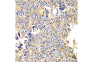 Immunohistochemistry of paraffin-embedded human prostate cancer using PICK1 antibody at dilution of 1:100 (x40 lens). (PICK1 抗体)