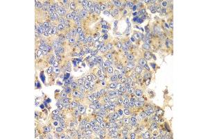 Immunohistochemistry of paraffin-embedded human prostate cancer using PICK1 antibody at dilution of 1:100 (x40 lens).