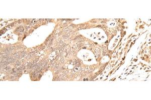 Immunohistochemistry of paraffin-embedded Human gastric cancer tissue using GRAP Polyclonal Antibody at dilution of 1:40(x200) (GRAP 抗体)