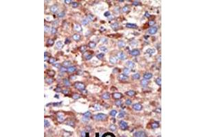 Formalin-fixed and paraffin-embedded human cancer tissue reacted with the primary antibody, which was peroxidase-conjugated to the secondary antibody, followed by DAB staining. (YY1 抗体  (AA 268-297))