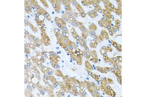 Immunohistochemistry of paraffin-embedded human liver injury using TOB2 antibody at dilution of 1:100 (x40 lens). (TOB2 抗体)