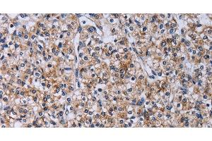 Immunohistochemistry of paraffin-embedded Human prostate cancer using CA4 Polyclonal Antibody at dilution of 1:30 (CA4 抗体)