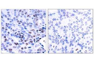Immunohistochemical analysis of paraffin-embedded human breast carcinoma tissue using NF-κB p105/p50 (Ab-337) antibody (E021017). (NFKB1 抗体)