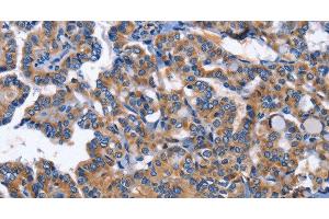 Immunohistochemistry of paraffin-embedded Human thyroid cancer using INHBC Polyclonal Antibody at dilution of 1:50 (INHBC 抗体)
